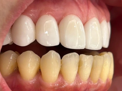 前牙美學+骨手術結合植牙重建